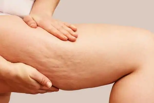 Image of woman showing leg with cellulite Prestwich