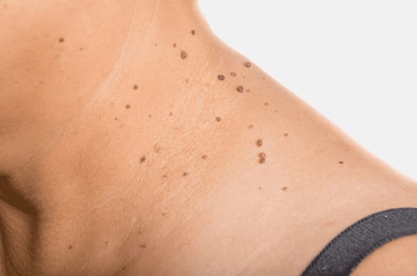 Are you looking for easy skin tag removal Prestwich - then contact Spire today!