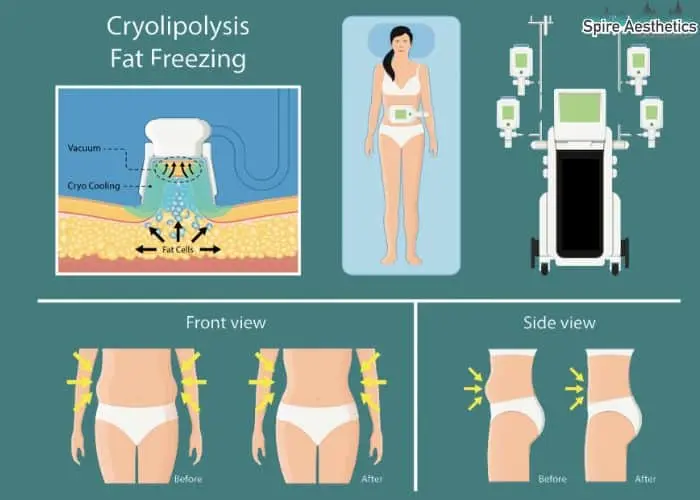 Fat freezing treatment Prestwich benefits for competitions to remove stubborn fat deposits.