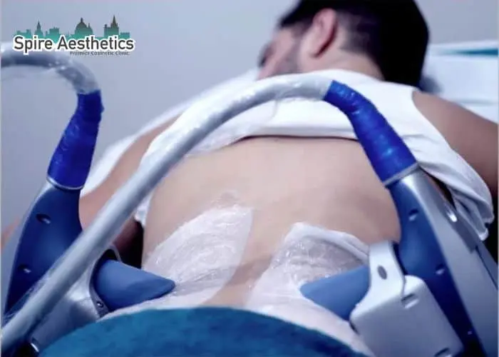 Man having fat freezing treatment done on love handles before a competitions Prestwich to create a sculpted look.