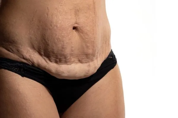 Image of womans stomach after weight loss injections Prestwich showing saggy skin